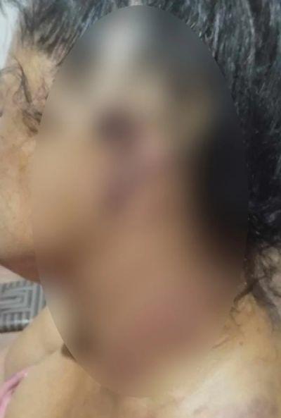 INTERIOR DE MT: Pitbull arranca orelha de tutora durante ataque