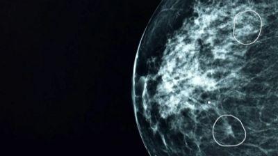 CÂNCER DE MAMA: A ferramenta de IA capaz de detectar tumores que passaram despercebidos por médicos
