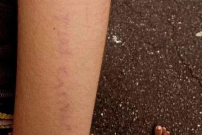 CRIME: Criança autista tem braço rabiscado com ofensas homofóbicas em escola