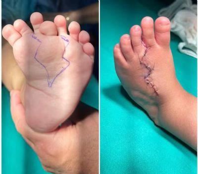FEITO INÉDIDO: Bebê que nasceu com o ‘pé duplicado’ passa por cirurgia inédita no Brasil, realizada em Cuiabá: ‘muito raro’, diz médico