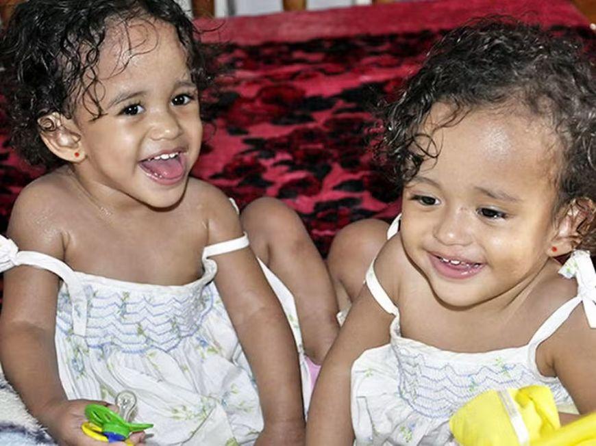 TikTok e vida no interior: como vivem as primeiras gêmeas siamesas de MT que passaram por cirurgia de separação há 15 anos